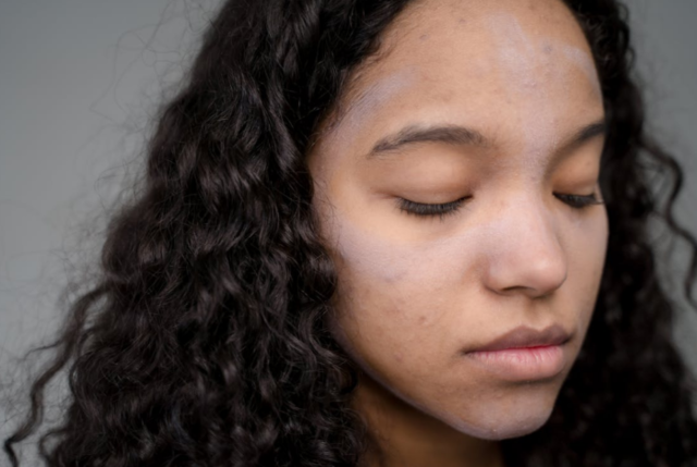 Tips if you have problem skin as a new mom