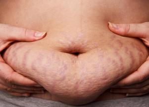 My post-baby body: It is more beautiful than it seems