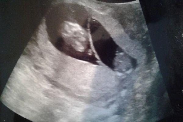 Unexpected news: The moment you discover youre having TWINS